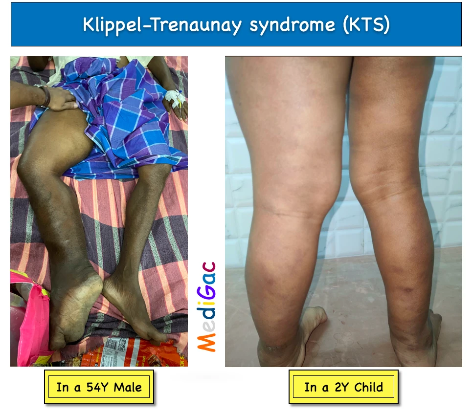 Klippel-Trenaunay syndrome